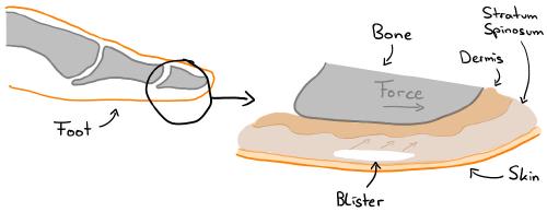 Over time, shear forces cause layers of skin to separate, forming a blister. (CC-BY 3.0)